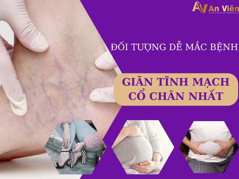 giãn tĩnh mạch cổ chân