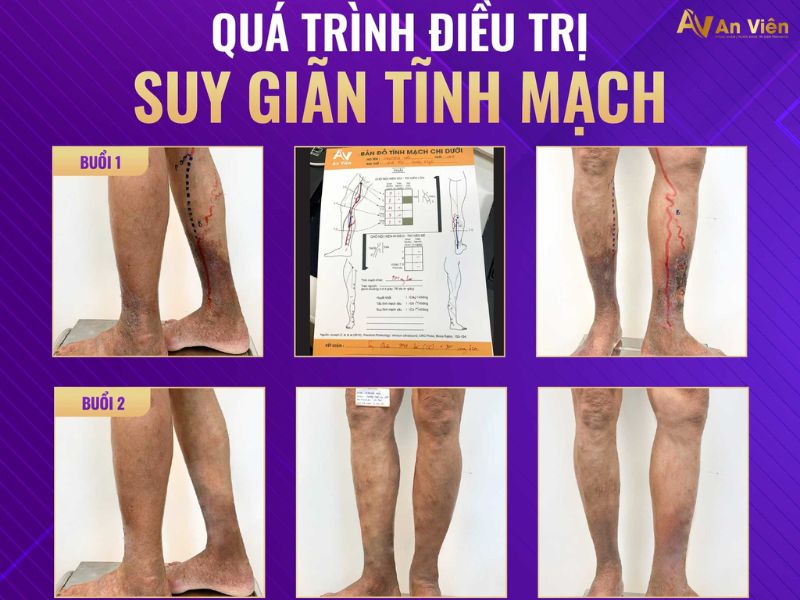 giãn tĩnh mạch là gì