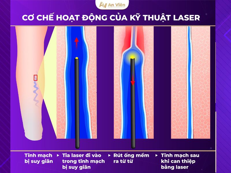 giãn tĩnh mạch là gì