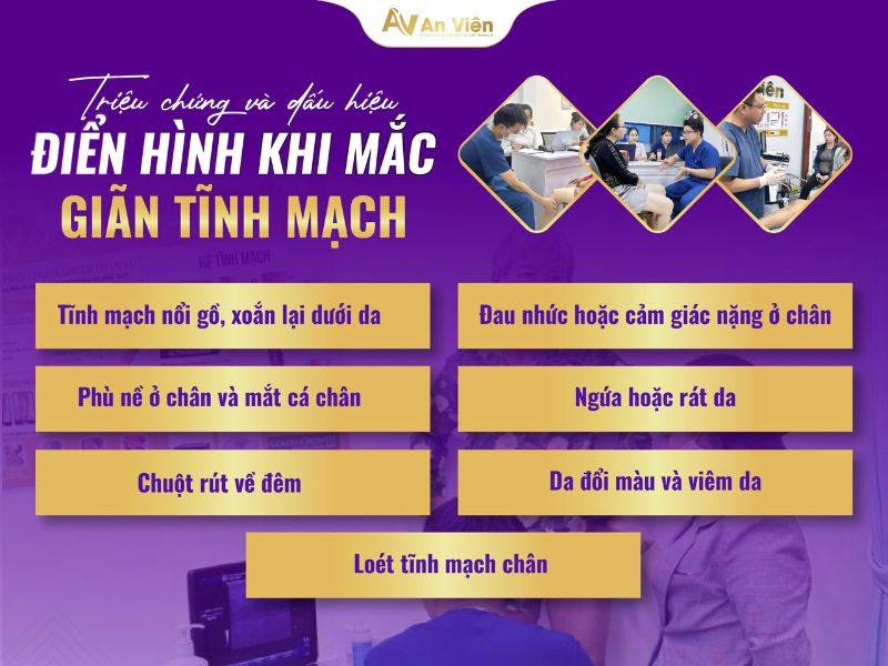 giãn tĩnh mạch là gì