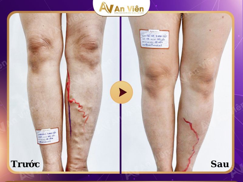 Giãn tĩnh mạch phải làm sao