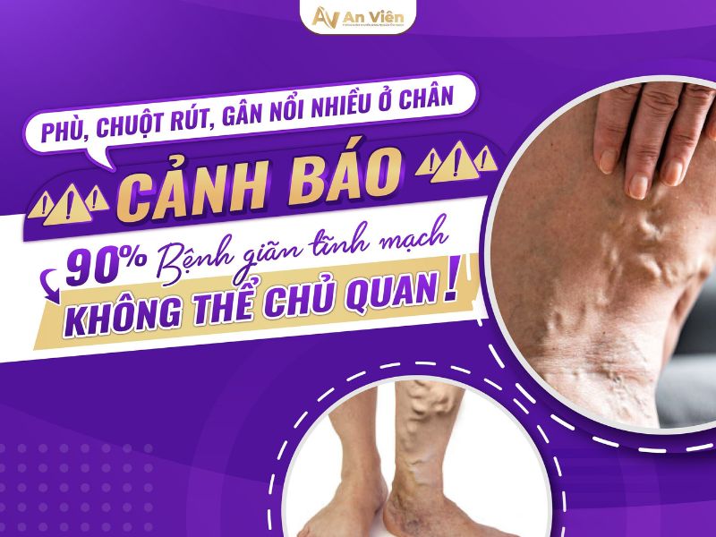 Giãn tĩnh mạch phải làm sao