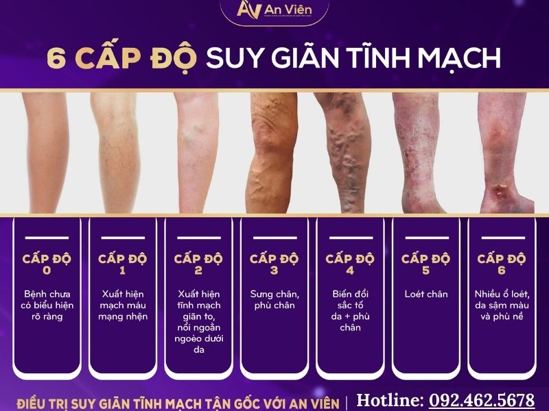 suy van tĩnh mạch chân