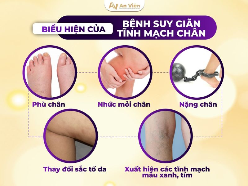 suy van tĩnh mạch chân