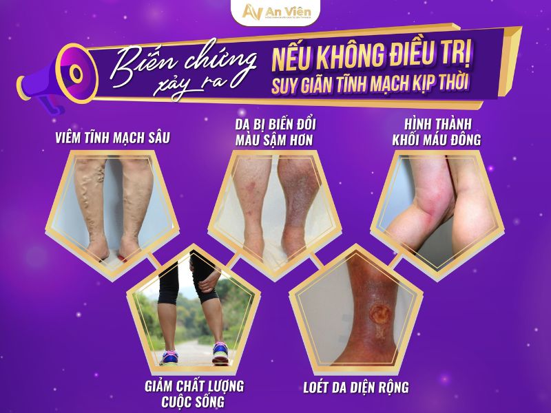 suy van tĩnh mạch chân