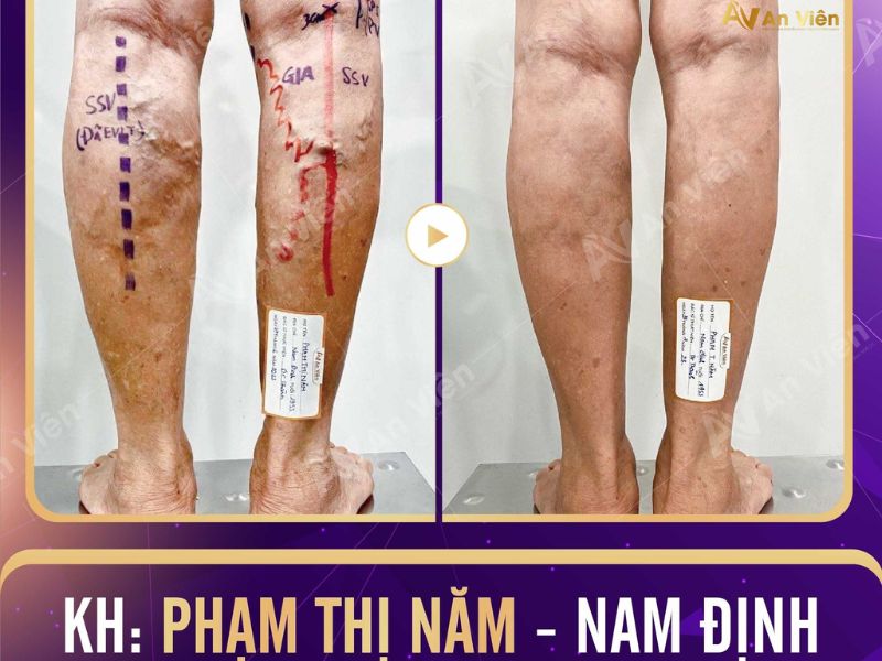 suy van tĩnh mạch chân