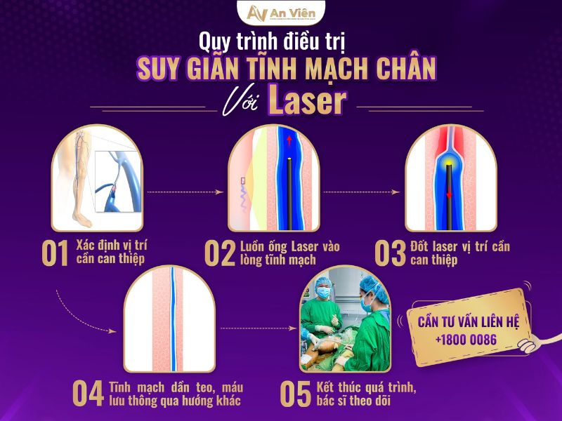 trị giãn tĩnh mạch