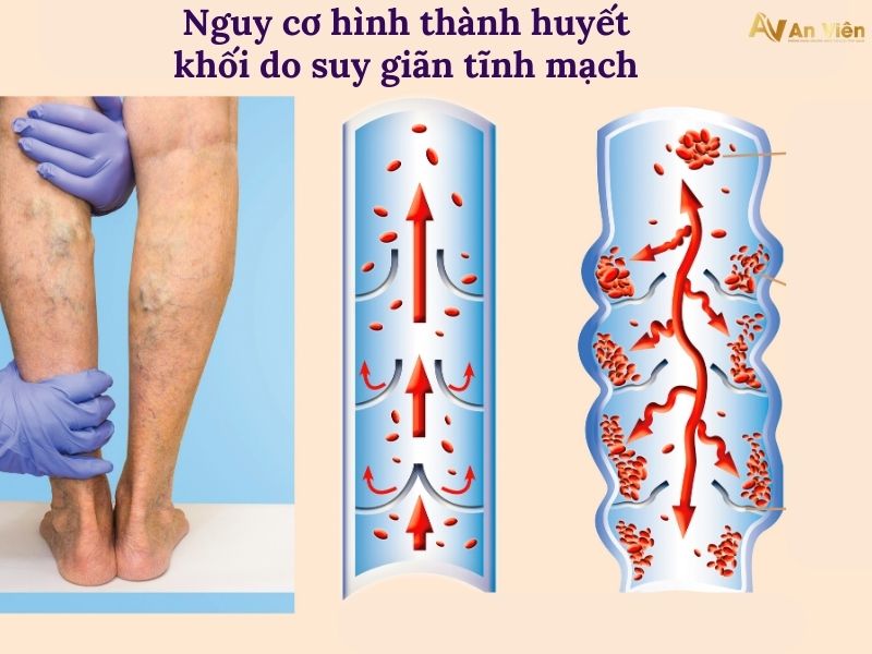 triệu chứng bệnh giãn tĩnh mạch