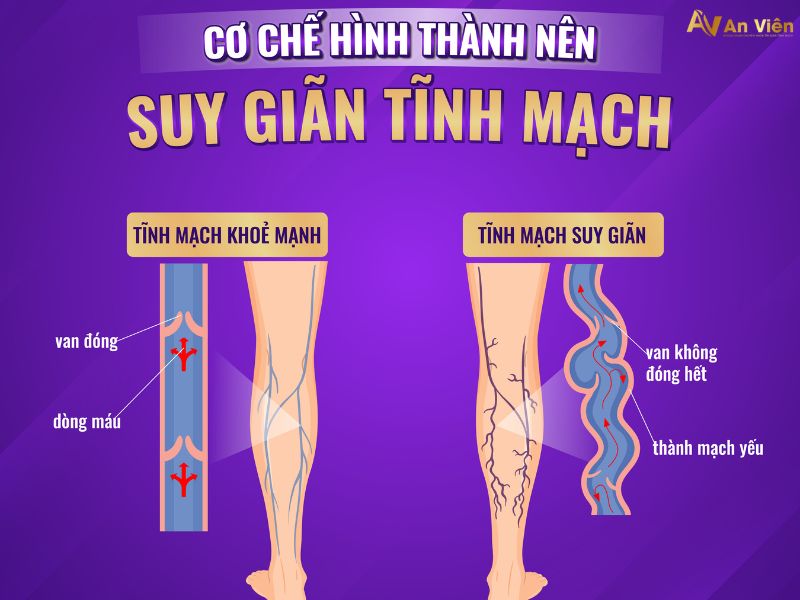 triệu chứng bệnh giãn tĩnh mạch