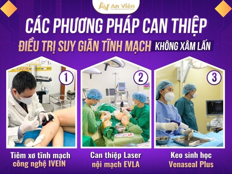 Bài tập trị suy giãn tĩnh mạch