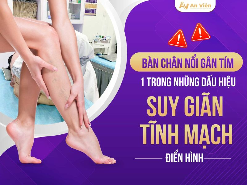 bàn chân nổi gân tím