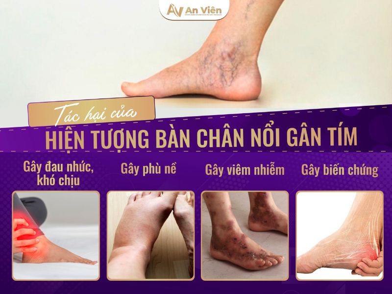 bàn chân nổi gân tím