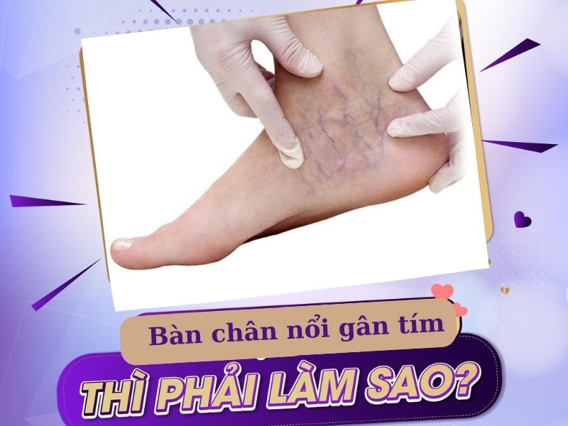 bàn chân nổi gân tím