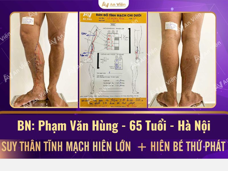 bệnh giãn tĩnh mạch ở chân