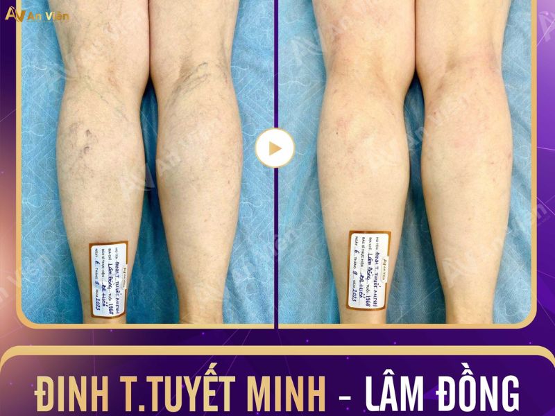 bệnh giãn tĩnh mạch ở chân
