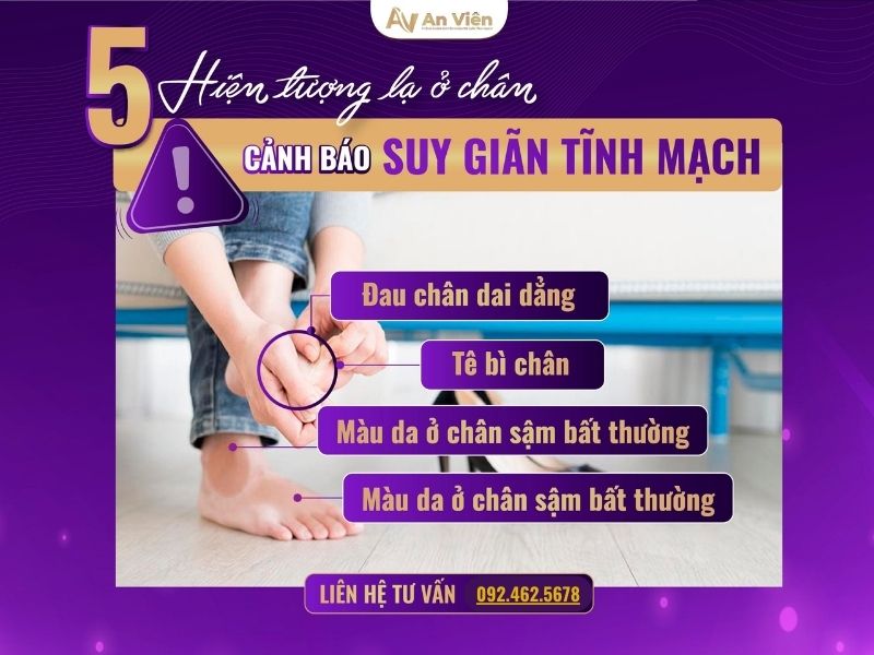 bệnh giãn tĩnh mạch ở chân