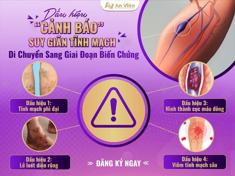 Bệnh suy giãn tĩnh mạch