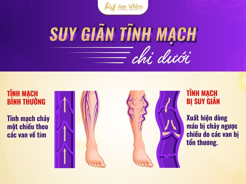 dấu hiệu của suy giãn tĩnh mạch