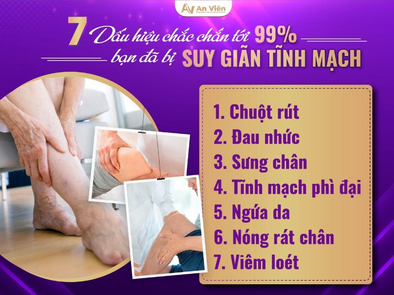 dấu hiệu của suy giãn tĩnh mạch
