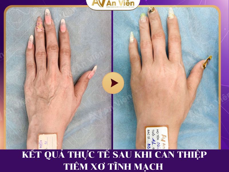 gân tay nổi nhiều phải làm sao