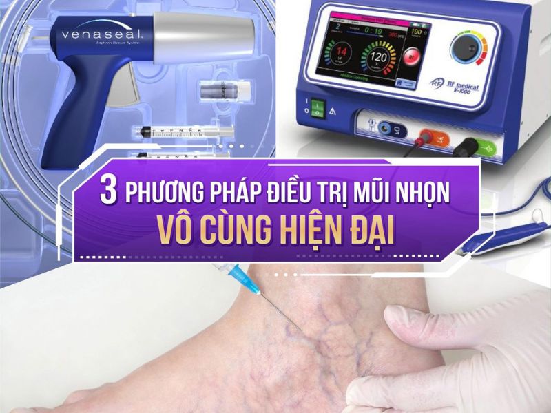 giảm đau giãn tĩnh mạch