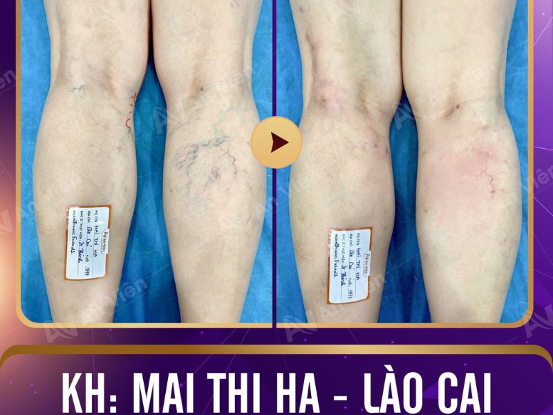 giãn tĩnh mạch
