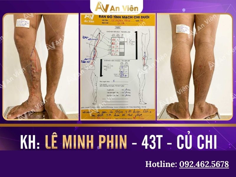 giãn tĩnh mạch