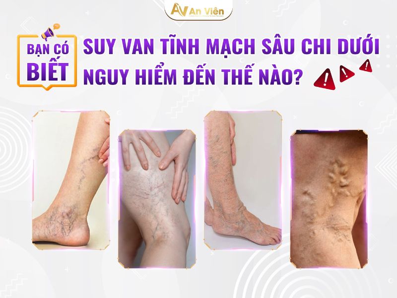 giãn tĩnh mạch