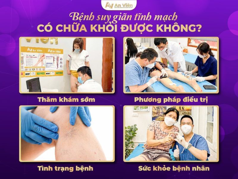 giãn tĩnh mạch chữa như thế nào