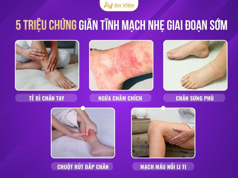 giãn tĩnh mạch nhẹ