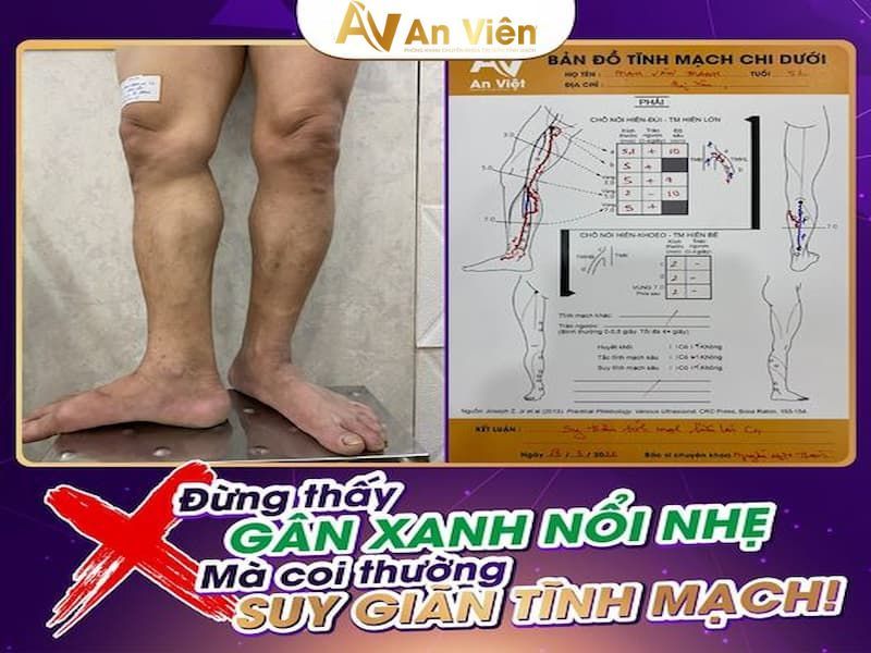 giãn tĩnh mạch nhẹ