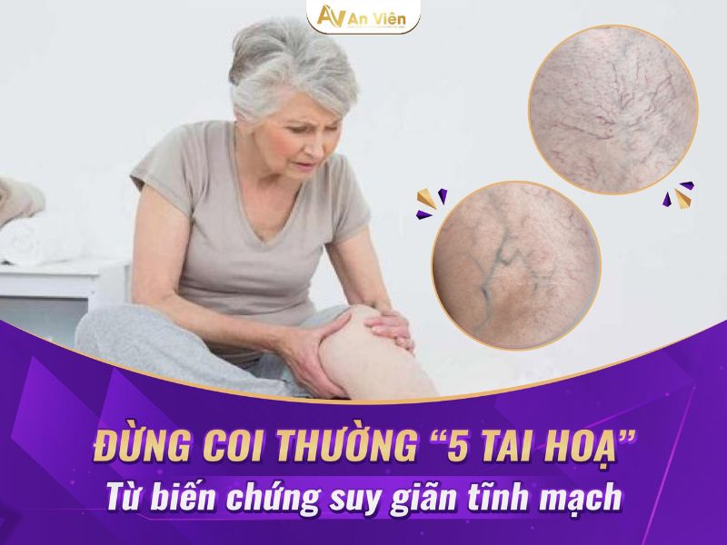 giãn tĩnh mạch nhẹ
