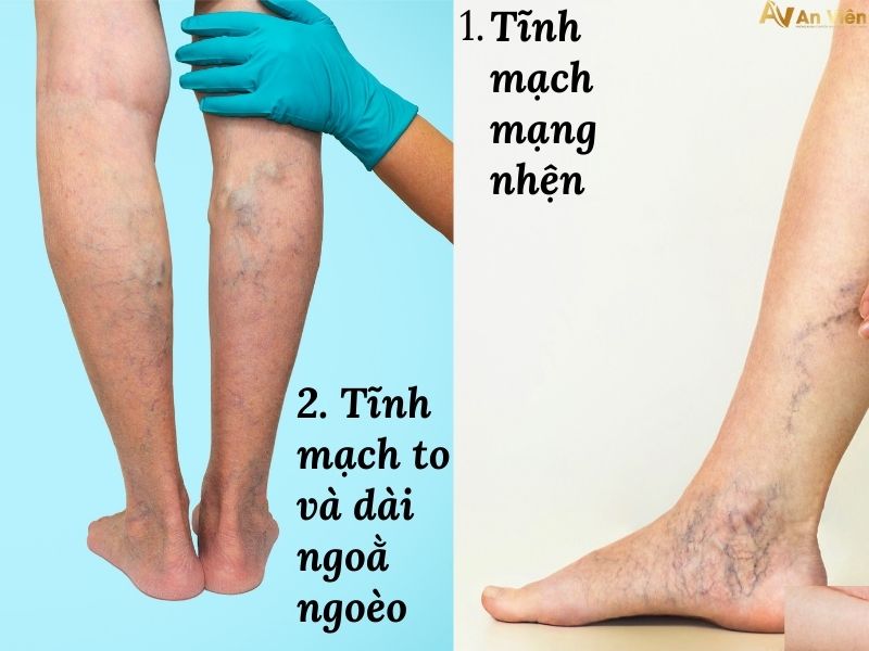 bàn chân nổi gân xanh là bệnh gì