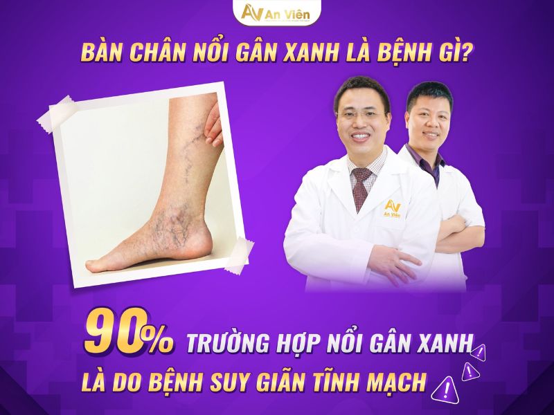 giãn tĩnh mạch là sao