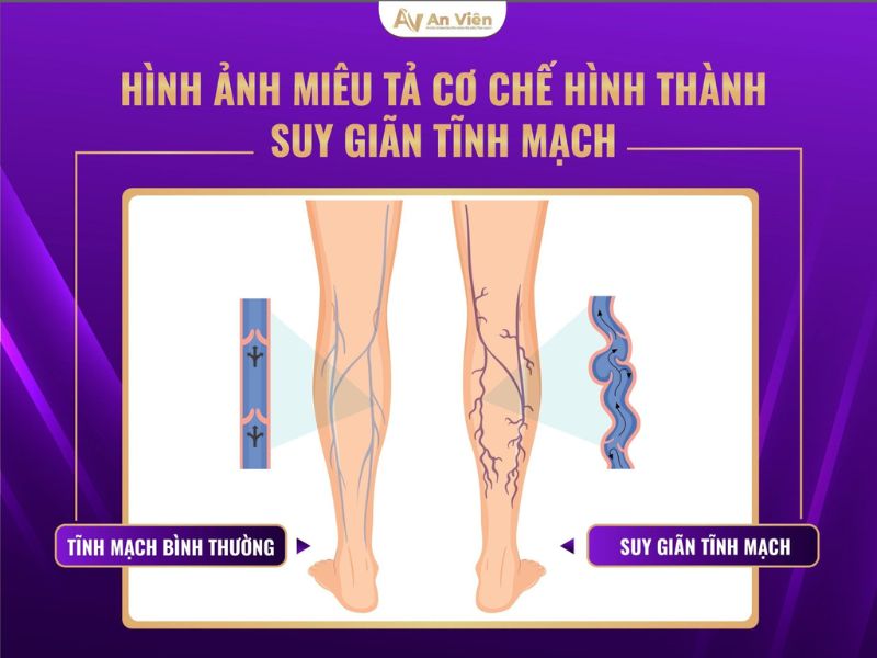 bệnh giãn tĩnh mạch có nguy hiểm không