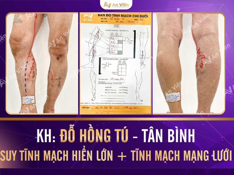 bệnh giãn tĩnh mạch có nguy hiểm không