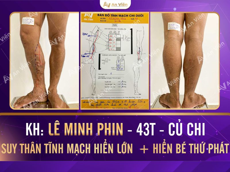 bệnh suy van tĩnh mạch chân