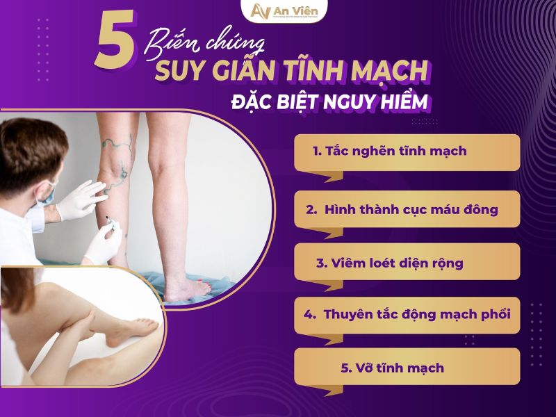 bệnh suy van tĩnh mạch chân