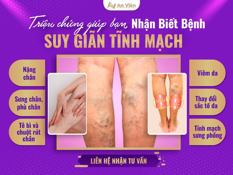 bệnh suy van tĩnh mạch chân