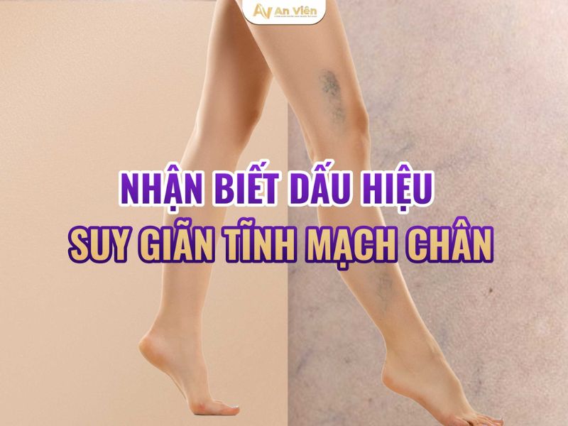 bệnh suy van tĩnh mạch chân