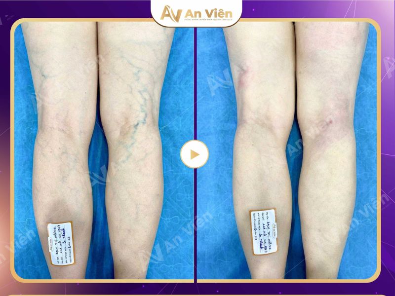 cách chữa trị bệnh giãn tĩnh mạch