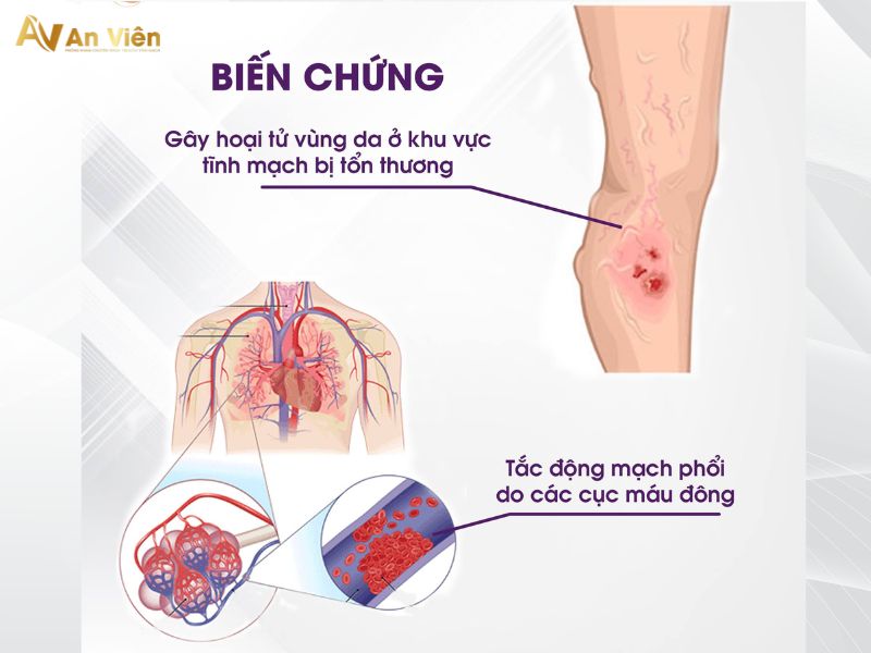cách chữa trị bệnh giãn tĩnh mạch