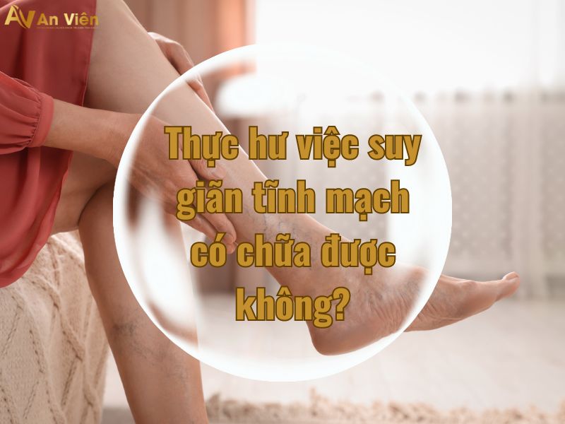 cách chữa trị bệnh giãn tĩnh mạch
