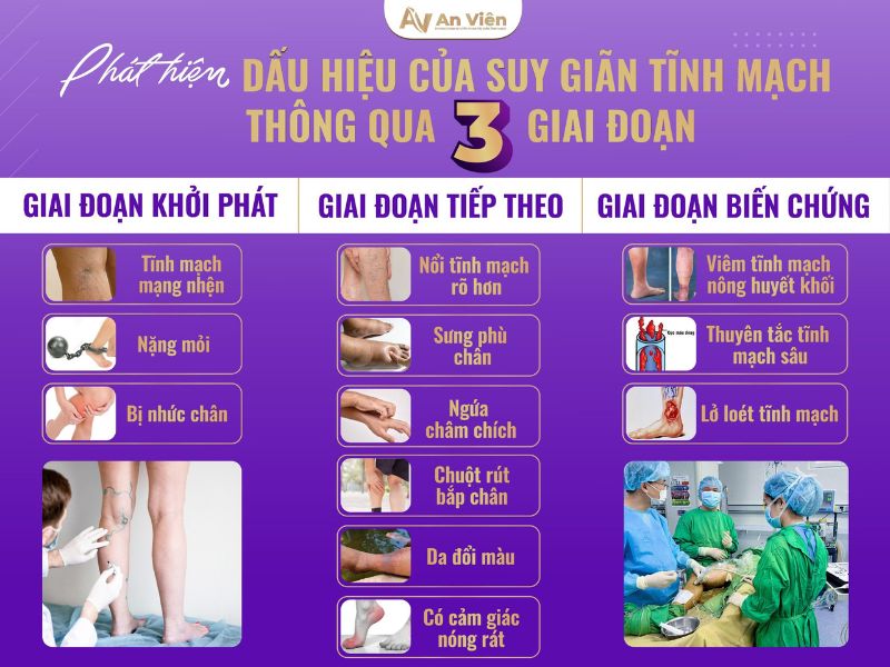 chân bị giãn tĩnh mạch phải làm sao
