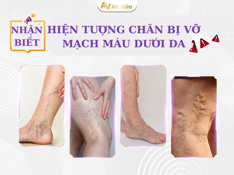 chân bị vỡ mạch máu dưới da