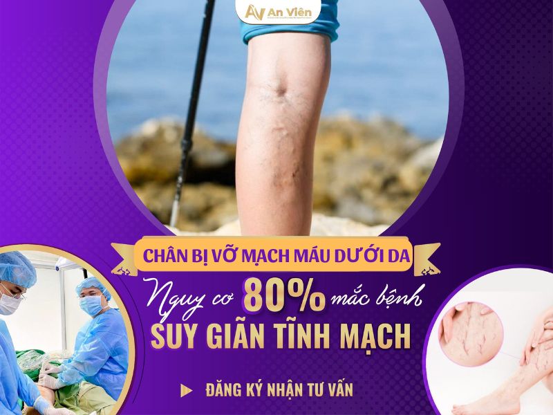 chân bị vỡ mạch máu dưới da