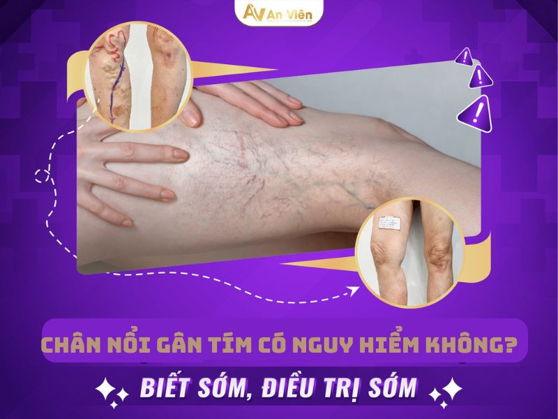 chân nổi gân tím