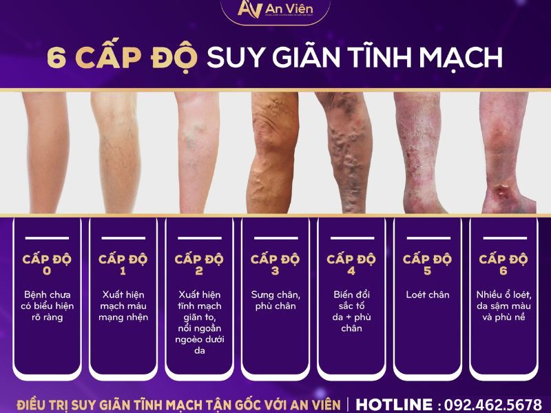 chân nổi gân tím