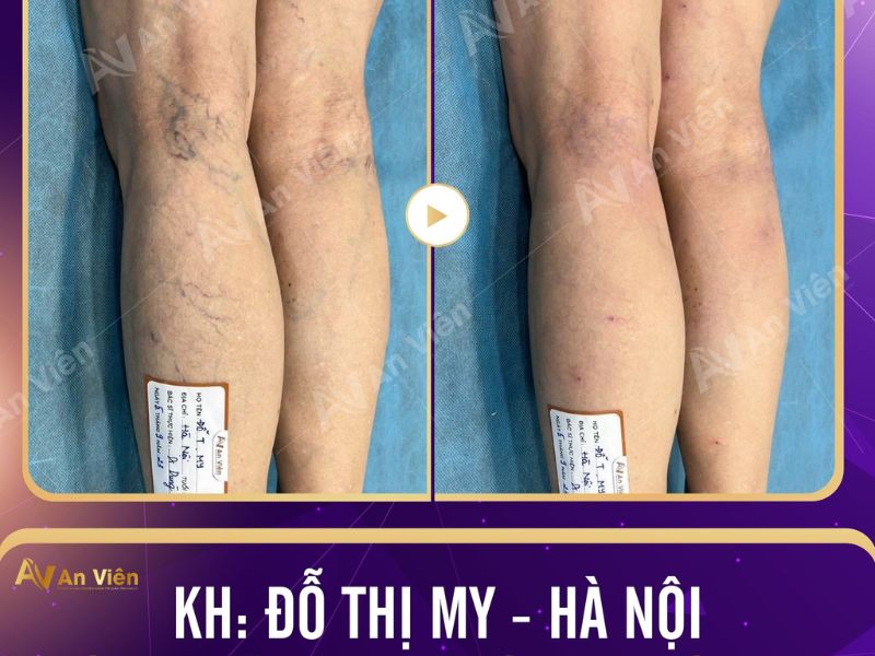 phẫu thuật giãn tĩnh mạch chân