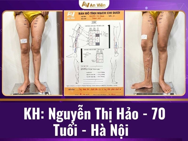 phẫu thuật giãn tĩnh mạch chân